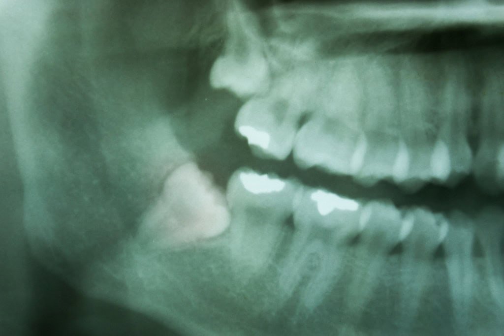radiografia exame de imagem dente odontologista dentista 1 1024x683